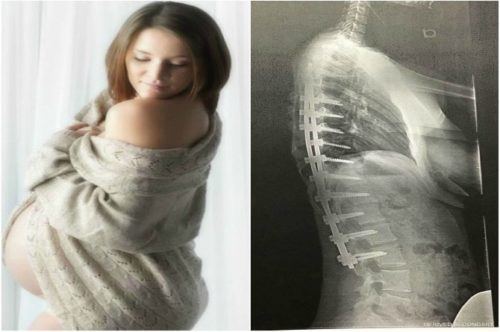 Mom shares: 'Scoliosis won't let me get into the birthing position'