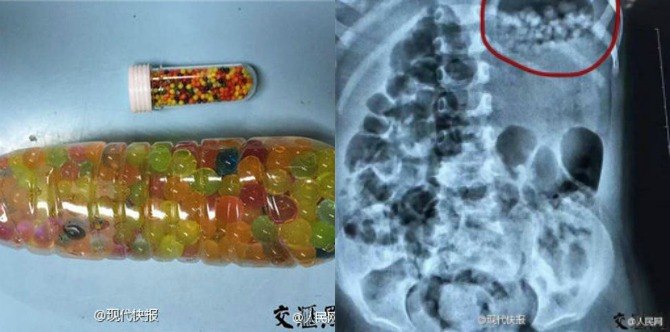 3-Year old eats 270 water-absorbing balls after parents mistake it for candy