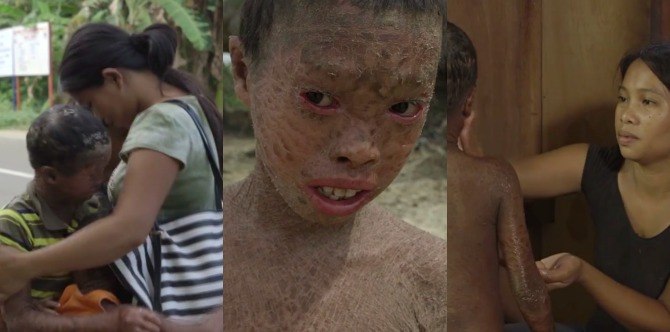 Single mom in Samar bravely raises 3 boys with the same severe skin condition
