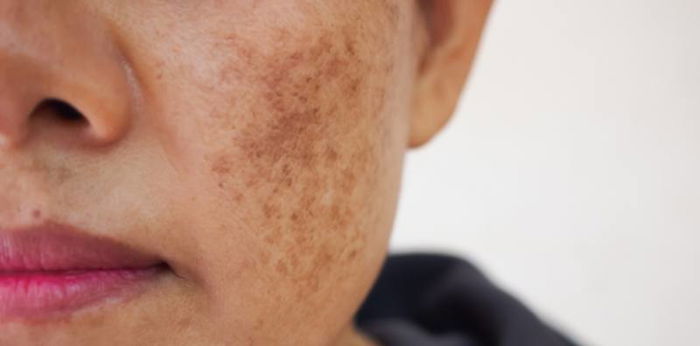 Melasma pregnancy: Signs and treatment of melasma during pregnancy