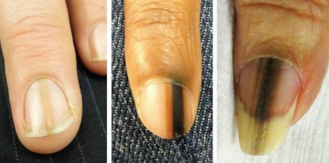 Having this mark on your fingernail can be a possible sign of melanoma