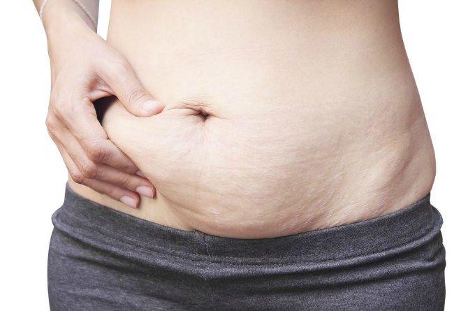 How to get rid of post-pregnancy cellulite the natural way