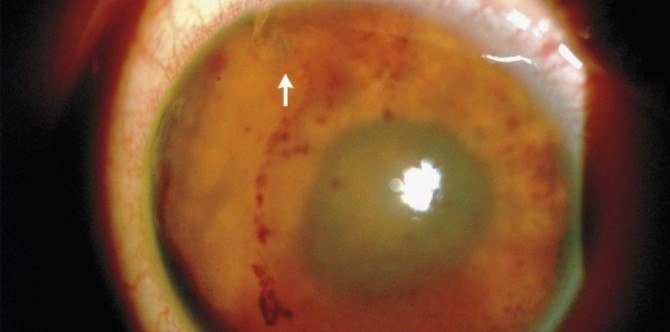 Parasitic worms found in teenager's eye, damaging his eyesight