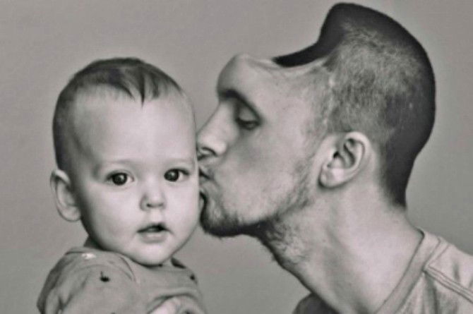 Could energy drinks cause a dad-to-be to lose half of his skull?