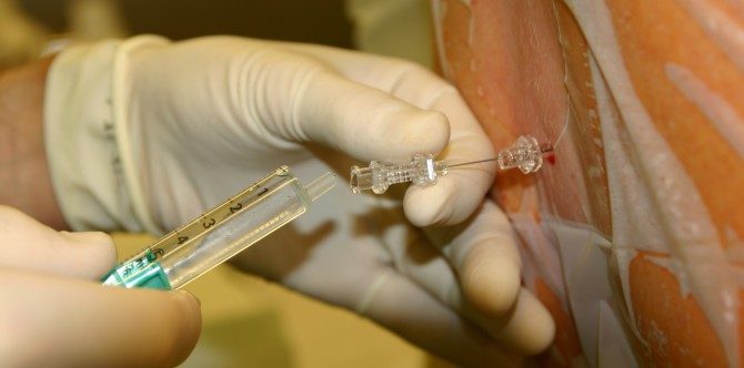 Can epidurals make your labor more difficult?