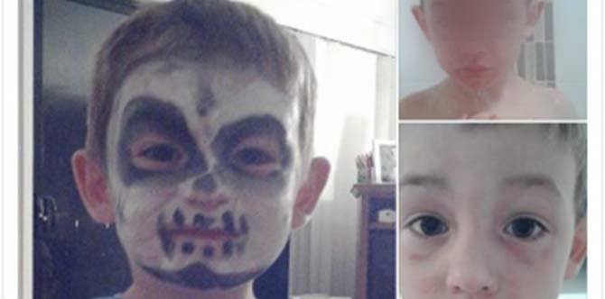 Face painting dangers: Child's face burned by Halloween face paint