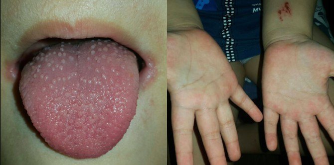 Mom shares son's battle with Kawasaki Disease to warn parents﻿