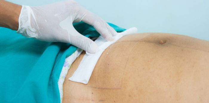 Post-cesarean wound infection: What you need to know