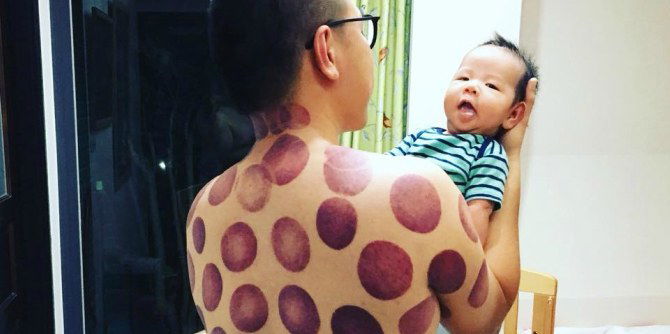 Cupping therapy: New dad shows off cupping marks on his back!