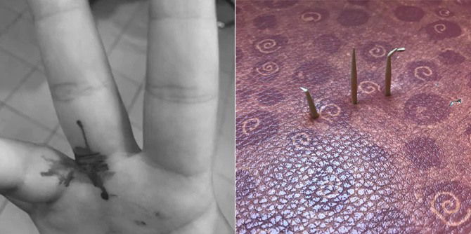 Girl hurt by 'protruding staples' on bus seat