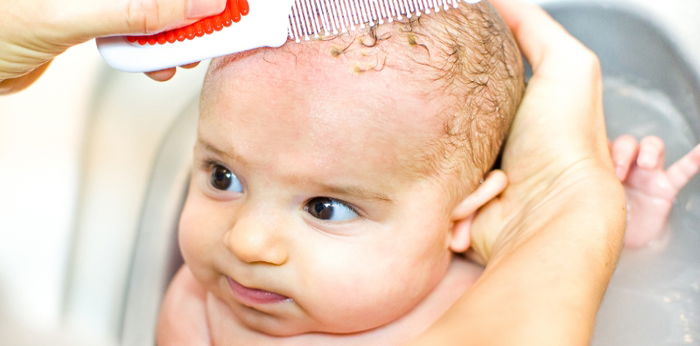 Newborn Guide: 10 bagay na dapat malaman tungkol sa cradle cap o langib sa ulo ni baby
