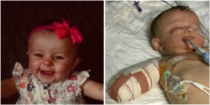 Meningitis in children: Little baby with meningitis loses all 4 limbs, family seeks help
