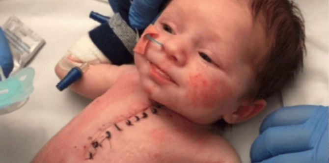 A week-old baby survives open heart surgery