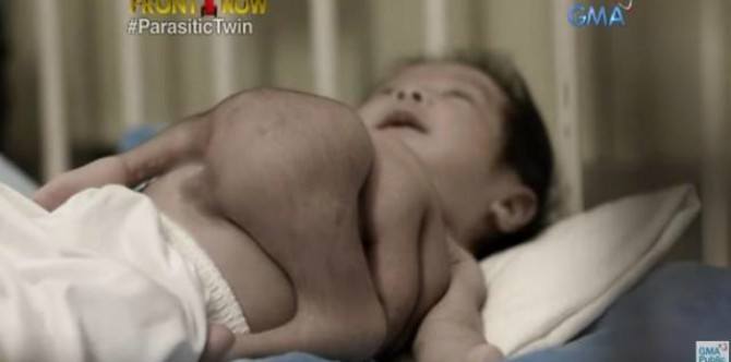 Parasitic twin removed from baby born with two sets of arms and legs