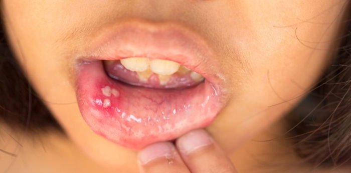 Gamot sa singaw: 10 epektibong home remedy para sa singaw sa dila at bibig