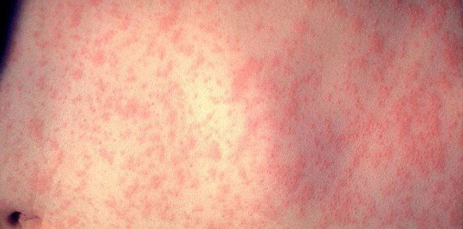 Measles outbreak in Taguig confirmed by DOH