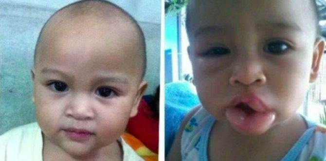 Child suffers bad Ibuprofen allergic reaction: Be aware of the risks