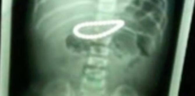 Toddler swallows 21 magnetic beads, baring dangers of magnetic toys