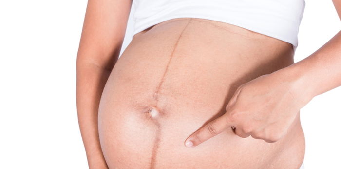 Linea Nigra: What you need to know about that dark line on your belly during pregnancy