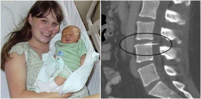 Broken epidural needle found in mom's spine 14 years later