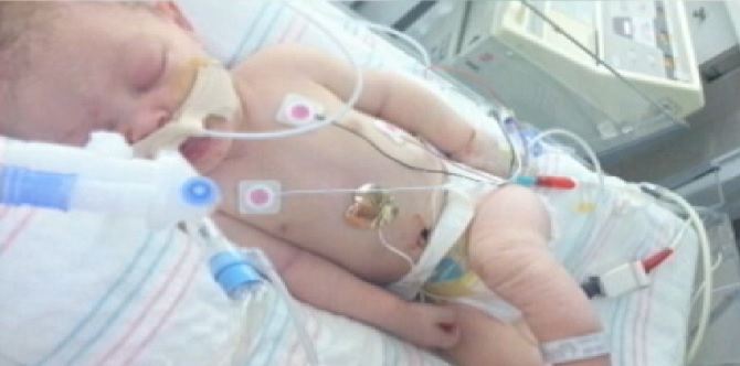 Baby dies 5 days after forceps delivery left her skull fractured