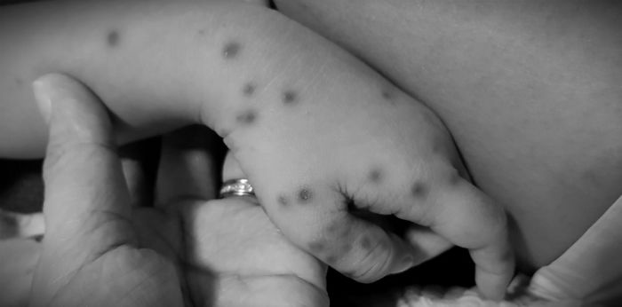 HFMD claims first victim, a 17-month-old baby