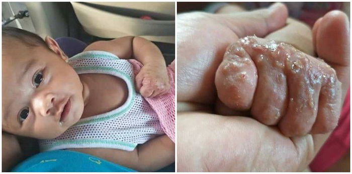 Scabies infections in babies: Do you know what to do?