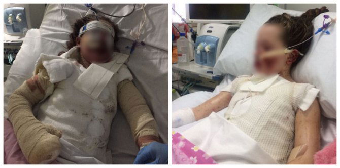 Bata nalapnos ang balat, nagdikit ang mata at bibig, dahil sa matinding reaksyon sa gamot