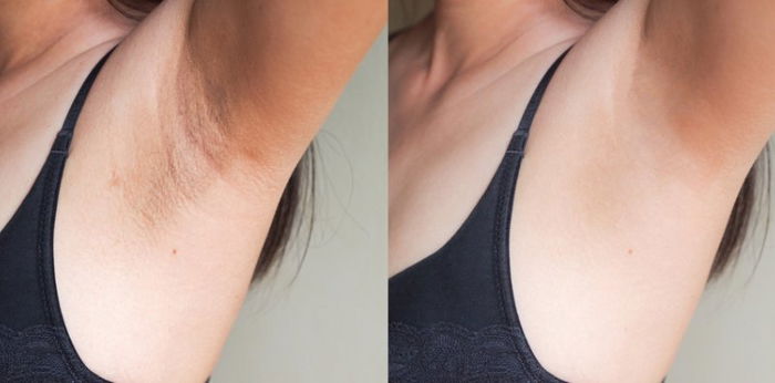 Maitim na kilikili? 12 iba't ibang natural na paraan pampaputi ng kilikili