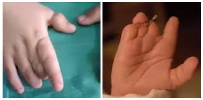 Ano ang amniotic band syndrome, at paano ito maiiwasan?