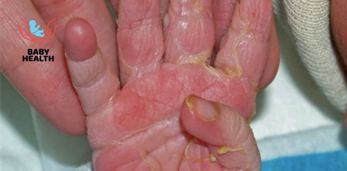 “Nagbabalat si baby!” Mga dapat alamin tungkol sa pagbabalat ng bagong-silang