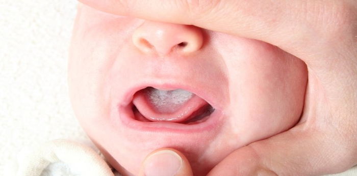 Milk tongue vs thrush in babies: What's the difference?