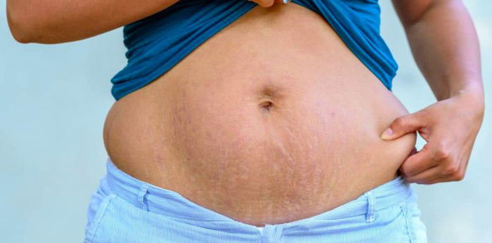 Ano ang safe na paraan para matanggal ang stretch marks?