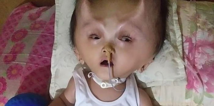 Hydranencephaly: Sakit na nag-iwan ng malaking uka sa ulo ng isang baby