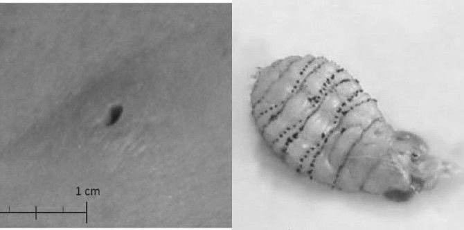 Ang inaakalang pigsa sa pepe, may laman palang itlog ng insekto!