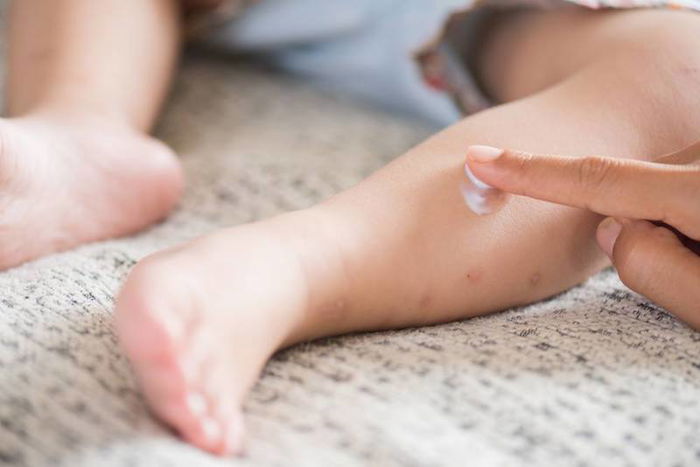 Helpful aid in relieving your child's eczema