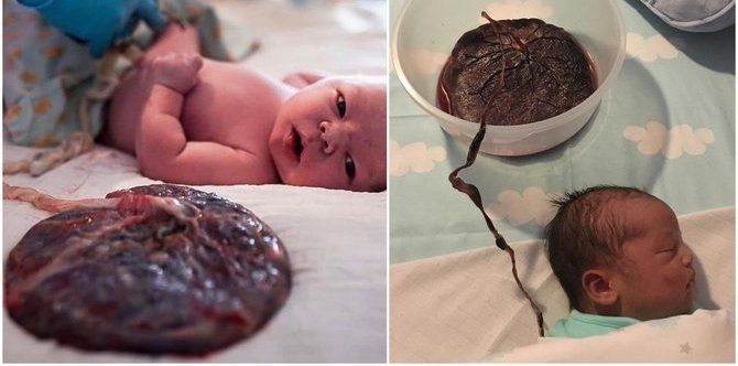 Ano ba ang lotus birth, at ligtas ba ito para sa mga ina?