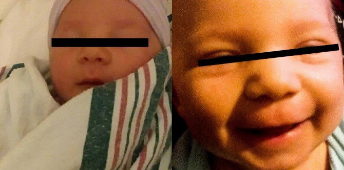 Sanggol patay matapos mahawa sa sakit na meningitis