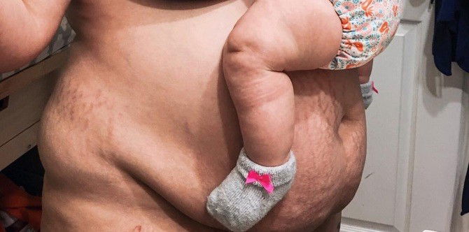 Lawlaw na tiyan matapos manganak, hindi dapat ikahiya