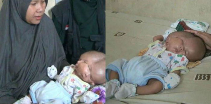 Baby born with two faces, two brains, and one head