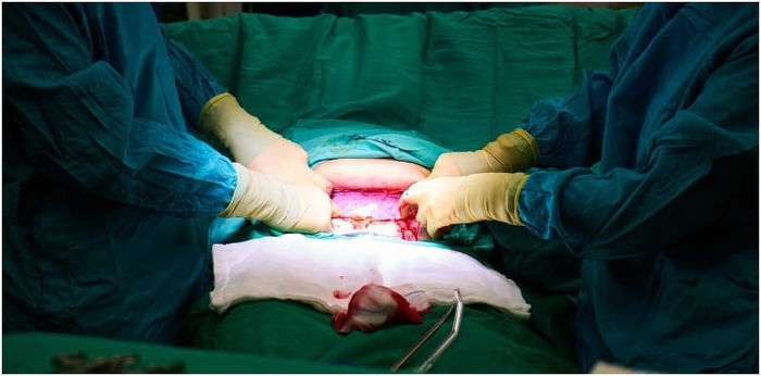 Mom and baby die after drunk doctor performs C-section