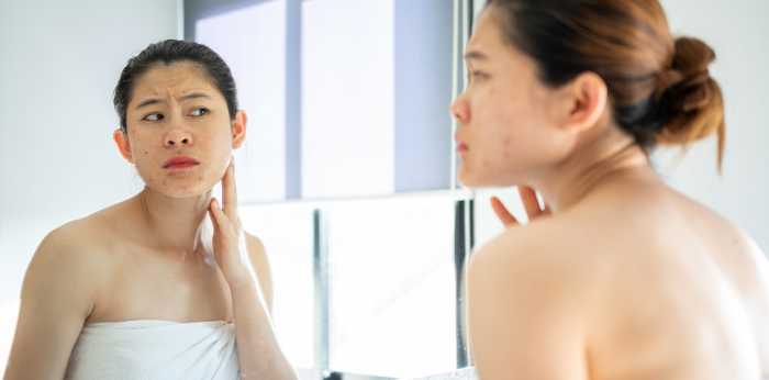 Bakit tinitigyawat ang buntis? 4 na posibleng dahilan ng tigyawat sa buntis