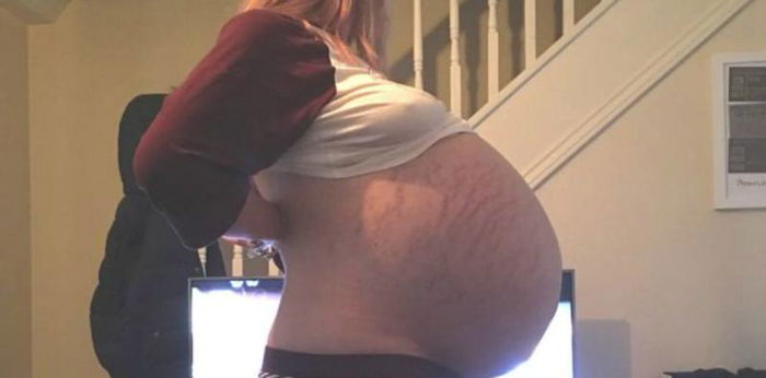 Woman had surgery to remove massive 26kg ovarian cyst
