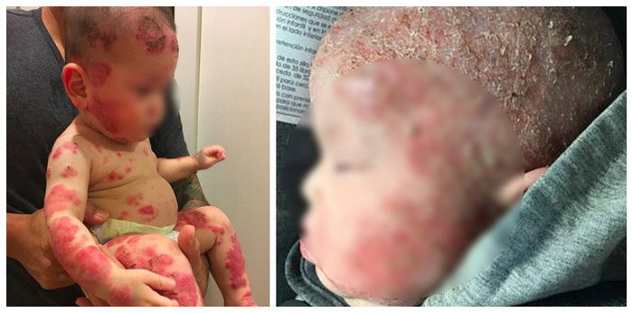 Bata, napuno ng sugat sa buong katawan dahil sa gamot sa eczema