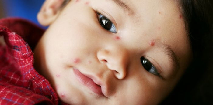 Bulutong tubig: Sanhi, sintomas, gamot, at mga paraan para maiwasan ang chickenpox