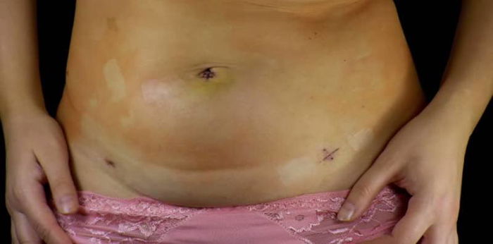 Can you get pregnant after an endometriosis treatment?