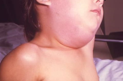 Mumps, measles, and rubella: A parent's guide to these diseases