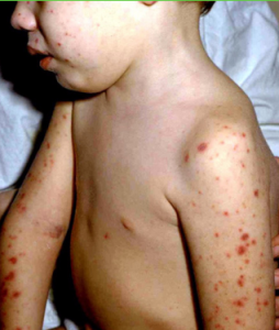 8 Mahahalagang Bagay na Dapat Tandaan Tungkol sa Meningitis at Meningococcemia