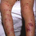 8 Mahahalagang Bagay na Dapat Tandaan Tungkol sa Meningitis at Meningococcemia