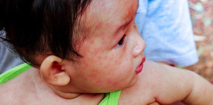UPDATE: Tigdas outbreak umabot na sa Visayas